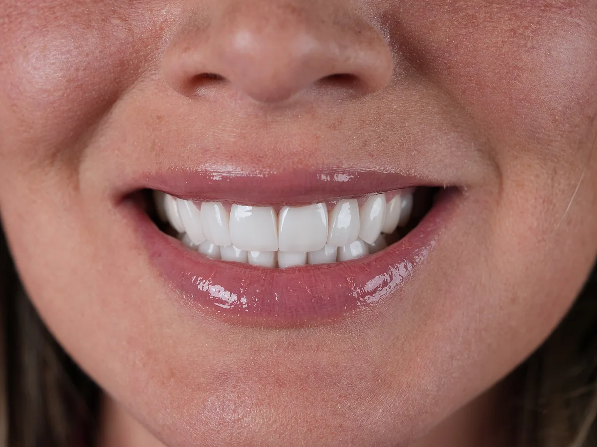 After — Rehabilitación de Sonrisa — Smile Dental Center