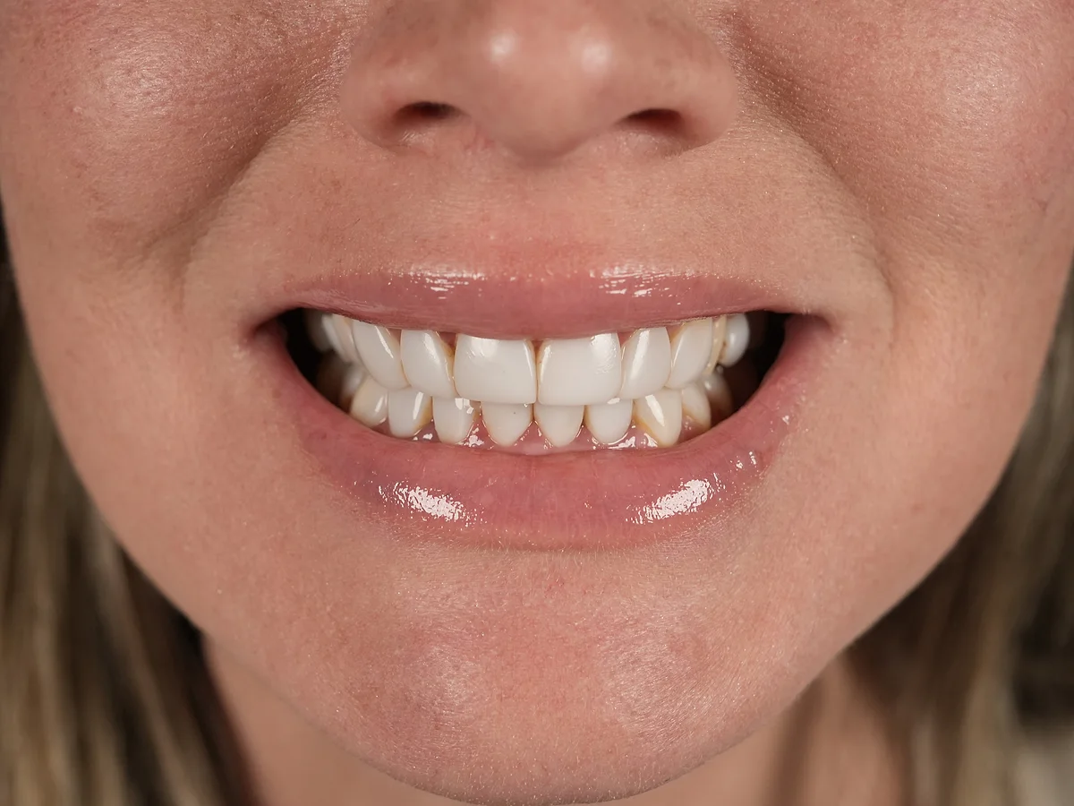 Before — Rehabilitación de Sonrisa — Smile Dental Center