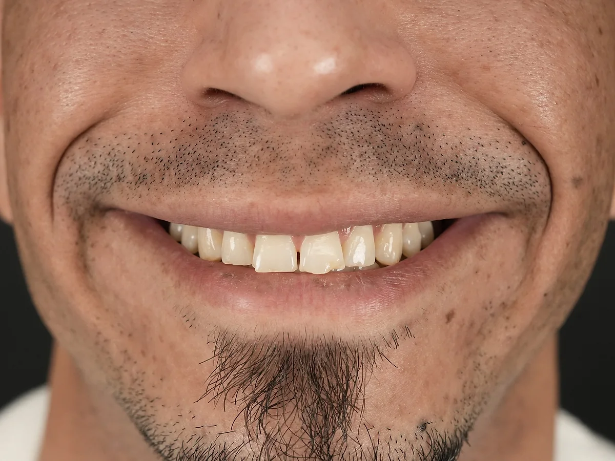 Before — Restauración con Implantes y Coronas